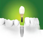 Имплантация зубов, установка зубных имплантатов