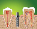 Имплантация зубов. Установка абатмента