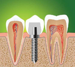 Имплантация зубов. Установка коронки на имплантат